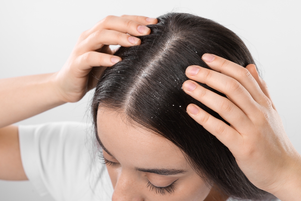 femeie cu scalp sensibil cu dermatita seboreica